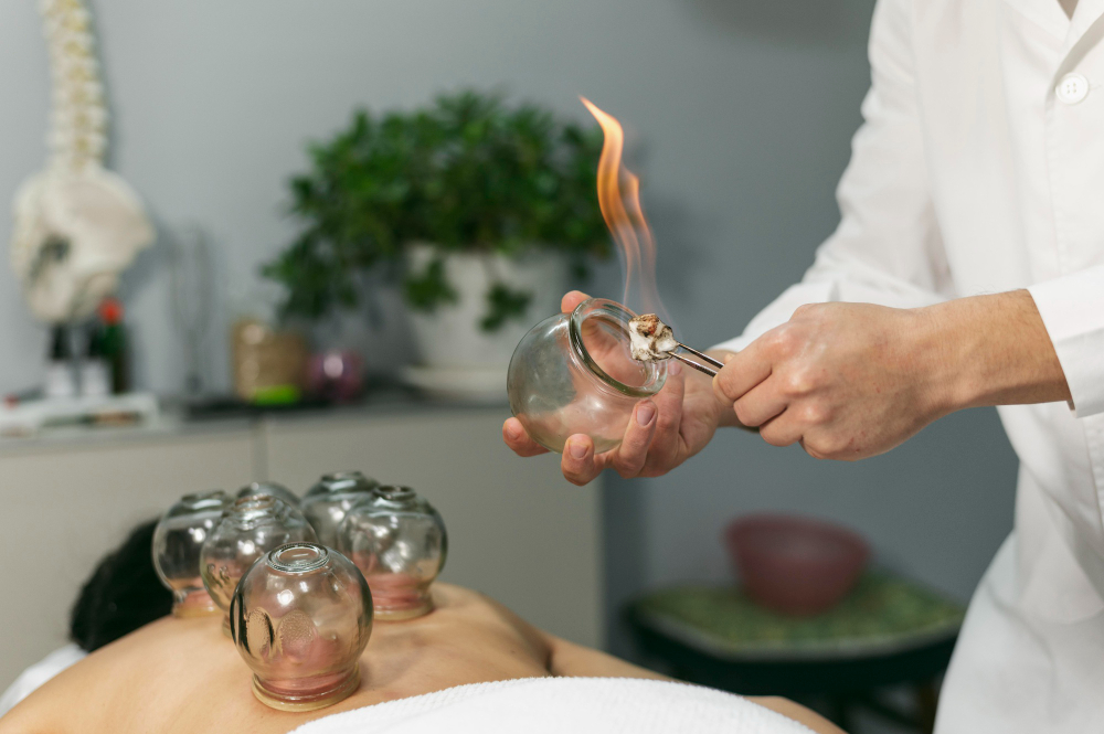 cupping therapy Lambeth